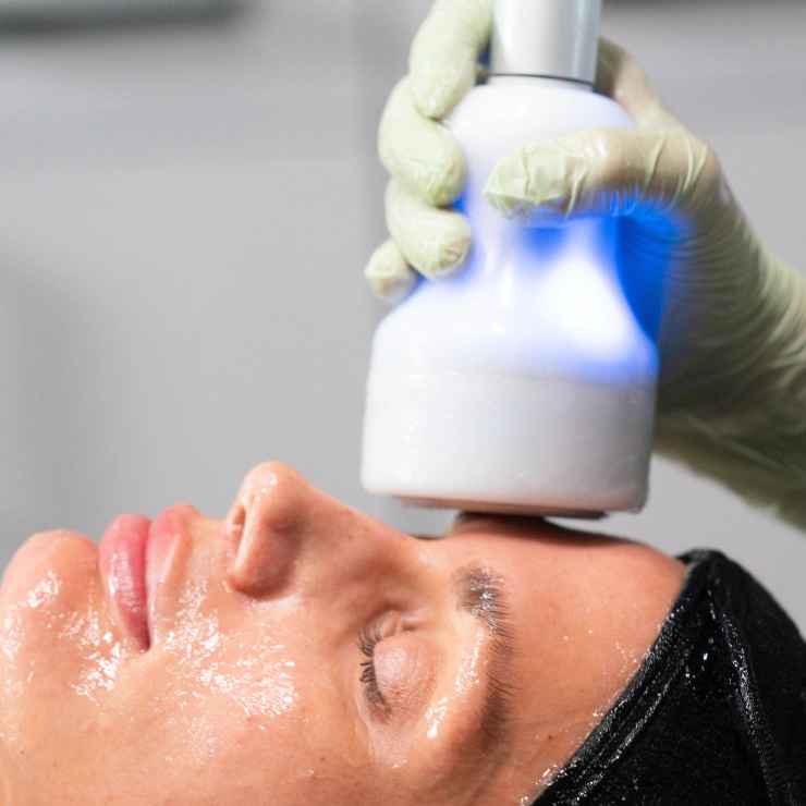 Woman receiving Neveskin™ Facial on her face